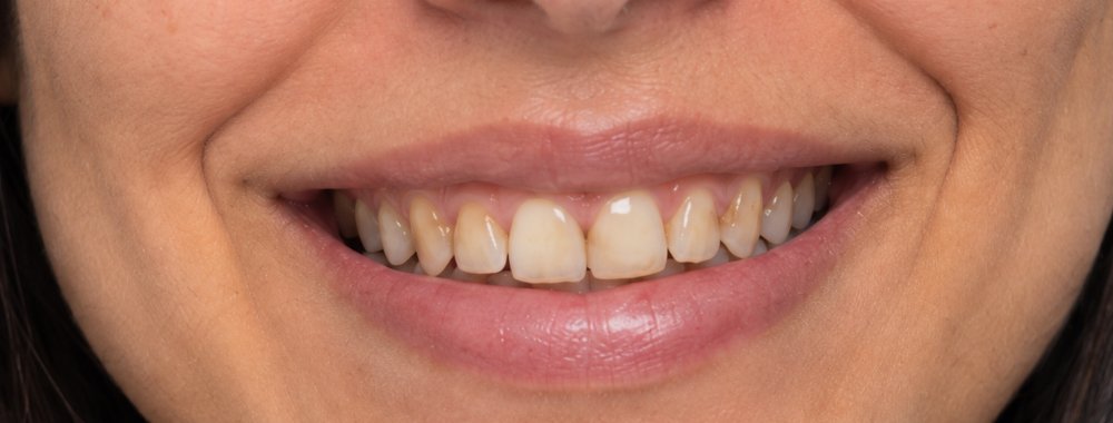 O mesmo sorriso antes do tratamento odontológico