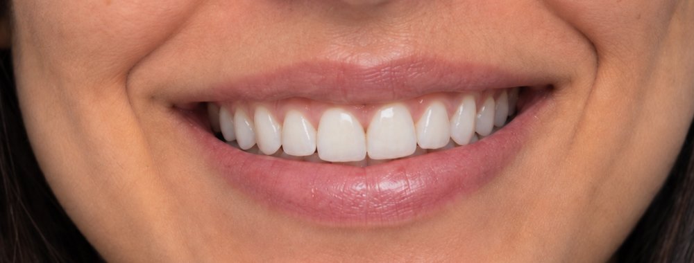 Sorriso depois do tratamento odontológico